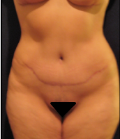 Abdominoplasty case 3a (with breast lift) – After