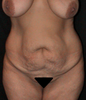 Abdominoplasty case 3a (with breast lift) – Before