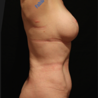 Abdominoplasty case 4 (with breast lifting, with implant) – After
