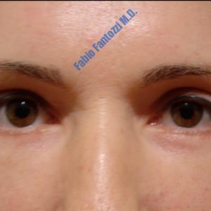 Blepharoplasty case 1 (upper- and lower eyelids) – After