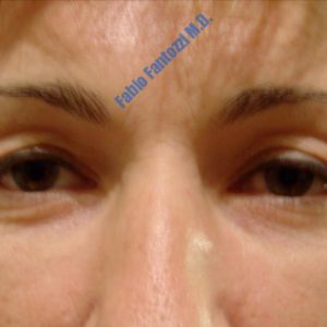 Blepharoplasty case 1 (upper- and lower eyelids) – Before