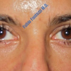 Blepharoplasty case 2 (upper- and lower eyelids) – After