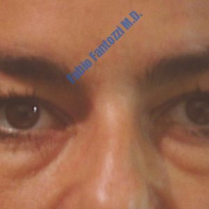 Blepharoplasty case 2 (upper- and lower eyelids) – Before