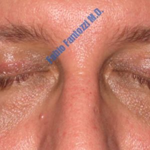 Blepharoplasty case 3 (upper eyelid) – After