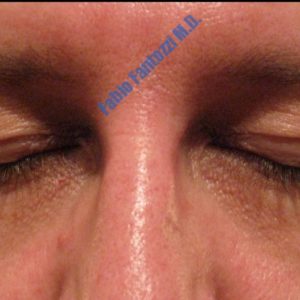 Blepharoplasty case 3 (upper eyelid) – Before