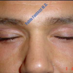Blepharoplasty case 4 (upper eyelid) – After