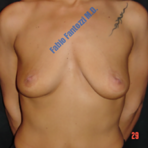 Breast augmentation case 2 – Before