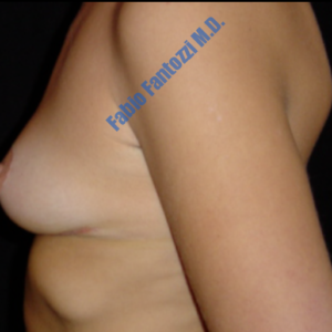 Breast lift case 6 – After