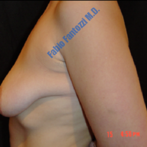 Breast lift case 6 – Before