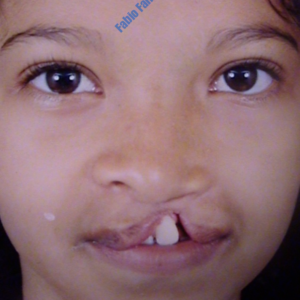 Correction of Cleft Lip – Before