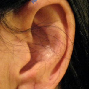 Ear Correction case 5 – After