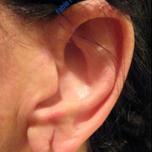 Ear Correction case 5 – Before