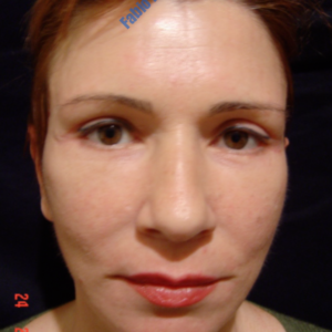 Face lift case 1 (including blefaroplasty) – After
