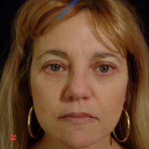 Face lift case 2a (including blefaroplasty) – After