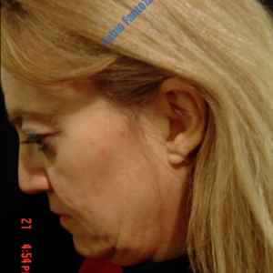 Face lift case 2b (side view, neck lift & liposuction) – Before