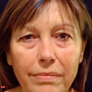 Face lift case 3a (including blefaroplasty) – Before