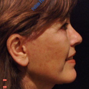 Face lift case 3b (side view, neck lift & liposuction) – After