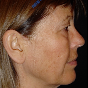 Face lift case 3b (side view, neck lift & liposuction) – Before