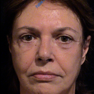 Face lift case 4 (including blefaroplasty) – After