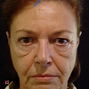 Face lift case 4 (including blefaroplasty) – Before