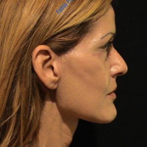 Face lift case 5 (mini face lift & blefaroplasty) – After