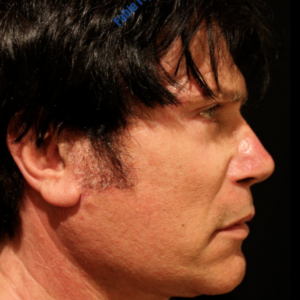Face lift (male) case 6 – After