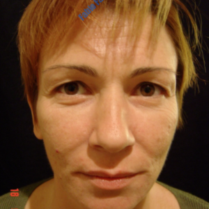 Facelift case 1 (including blefaroplasty) – Before