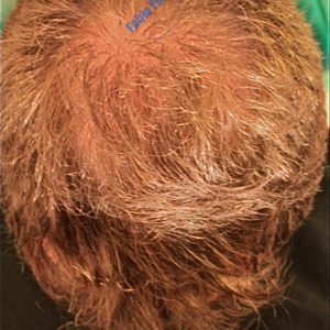 Hair Transplantation case 2 – After