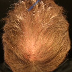 Hair Transplantation case 3 – After