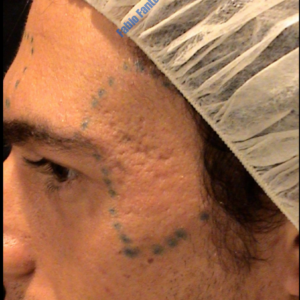Laser treatment case 1a – Before