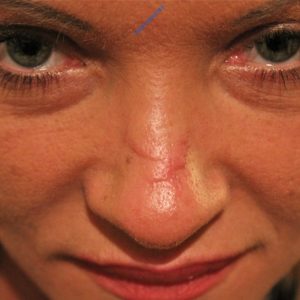 Laser treatment case 4 (scar removal) – Before