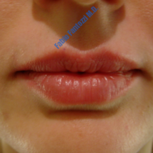 Lip enhancement case 1 – After