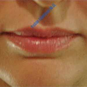 Lip enhancement case 1 – Before