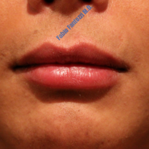 Lip enhancement case 2 – After