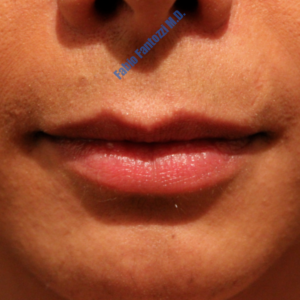 Lip enhancement case 2 – Before