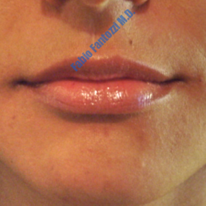 Lip enhancement case 4 – After