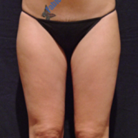 Liposuction case 2- Lipoaspiration in knee area – Before