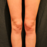 Liposuction case 3- Knee and calf lipoaspiration – After