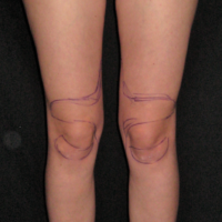 Liposuction case 3- Knee and calf lipoaspiration – Before