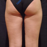 Liposuction case 5- Treatment of cellulite – Before