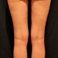 Liposuction case 6- Lipoaspiration of culottes, knees and calves – After