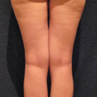 Liposuction case 6- Lipoaspiration of culottes, knees and calves – Before