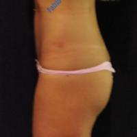 Liposuction case 7- Liposuction of abdominal region – After