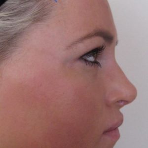 Rhinoplasty case 1 (nasal tip) – After