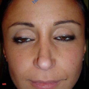 Rhinoplasty case 5 (nasal tip) – Before
