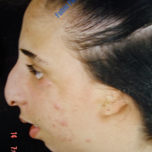 Treacher-Collins Syndrome, full profile reconstruction – Before
