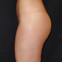 Treatment of abdominal and culottes areas – After