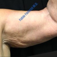Arm Lift case 3b – Before
