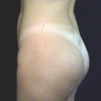 Gluteal Augmentation with implants, case 1a – After