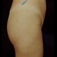 Gluteal Augmentation with implants, case 1b – Before